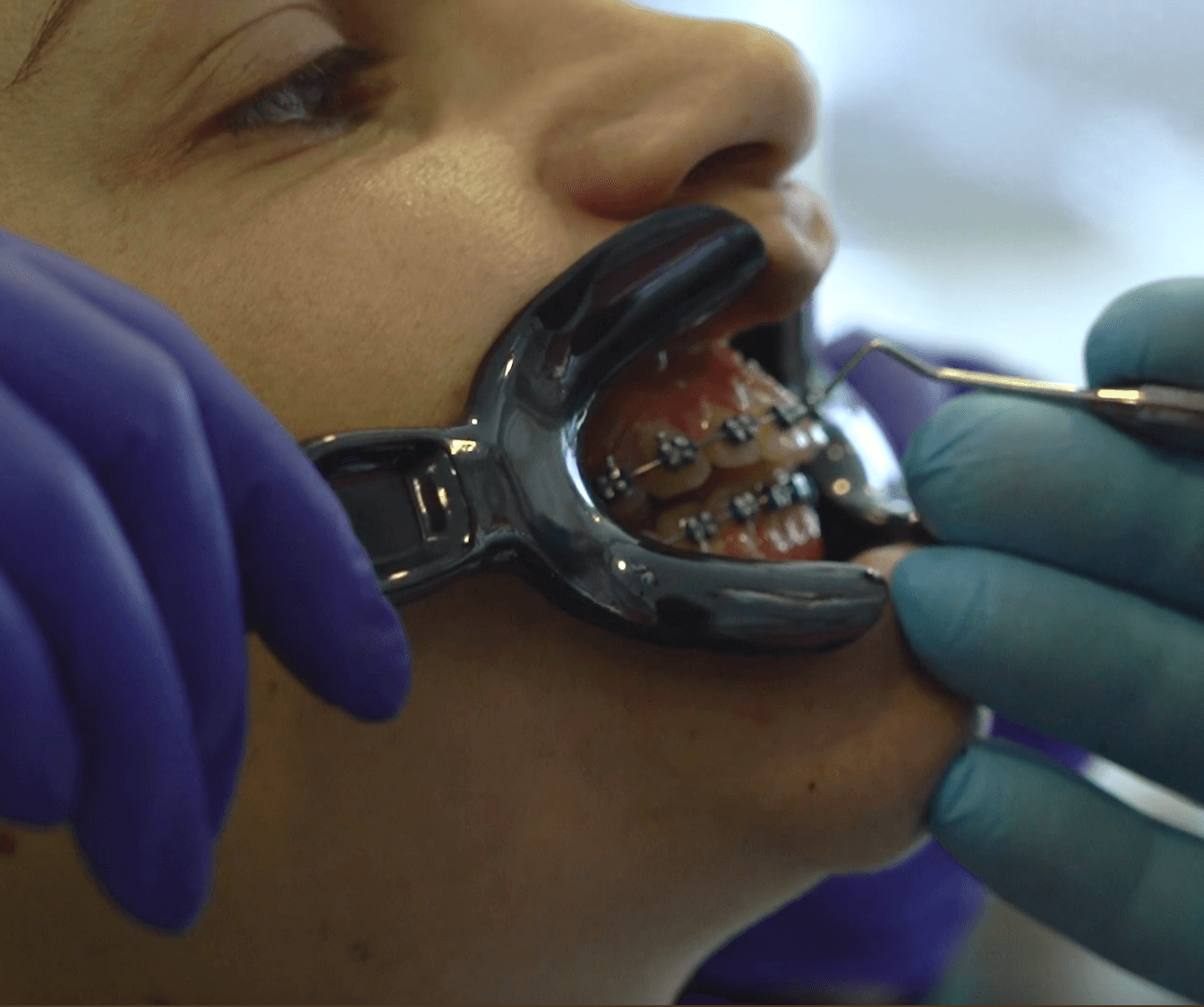 aparelhos dentários estéticos